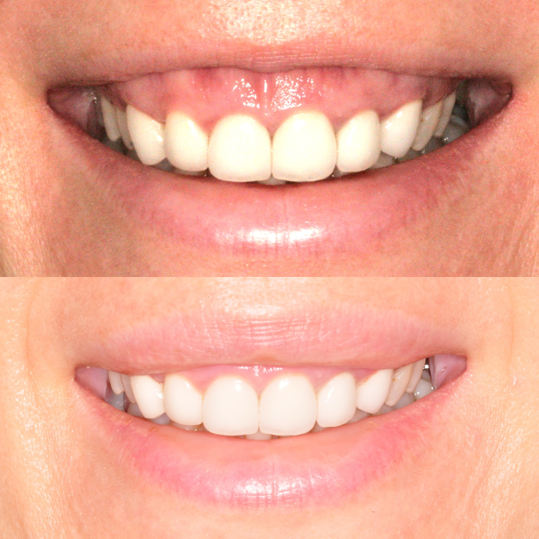 Lip Repositioning: A Simple Solution for a Gummy Smile