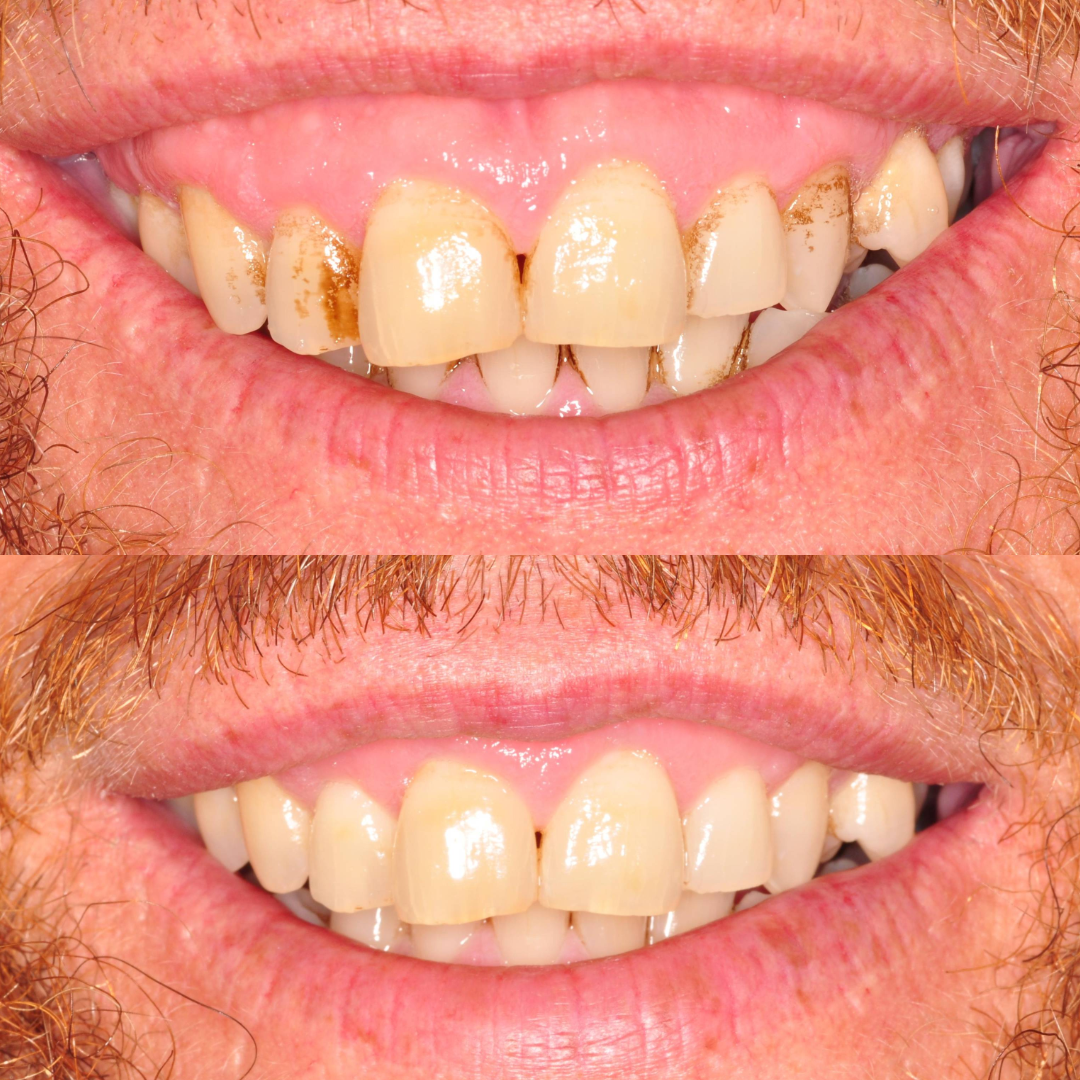 Gummy Smile Before and after
