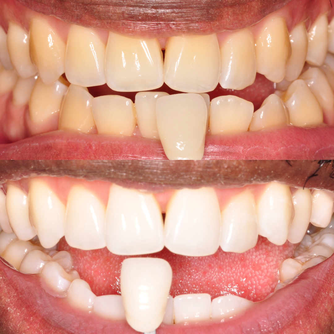 Before and after teeth whitening